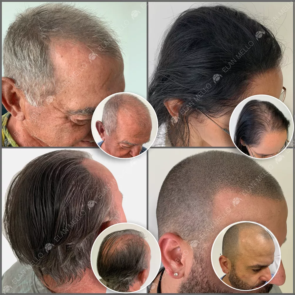 Quatro pessoas exibindo técnicas capilares diferentes. Dois homens e uma mulher com cabelos longos mostram micropigmentação capilar para densidade, enquanto um homem com cabelo raspado apresenta a técnica fio a fio